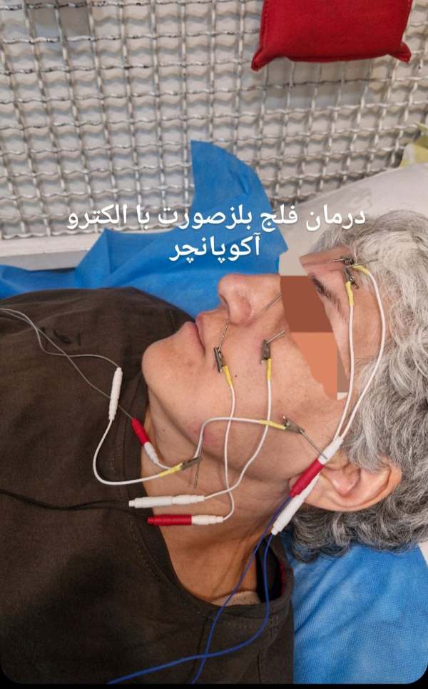 طب‌سوزنی الکتریکی (الکتروآکوپانچر)